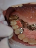 Patologiczne starcie zębów – odbudowa zwarcia, opis przypadku