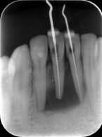 Leczenie endodontyczne zębów przed planowanym zabiegiem usunięcia torbieli korzeniowej – opis przypadku