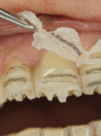 Planowanie leczenia estetycznego z zastosowaniem wax-up oraz mock-up