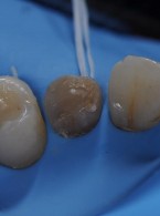 Zachowawcza odbudowa przetrwałego zęba mlecznego
