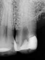 Złamane narzędzie kanałowe - powikłanie w endodoncji, z którym można sobie poradzić