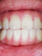 Perforacje jako powikłanie leczenia endodontycznego – postępowanie kliniczne