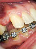 Most adhezyjny jako alternatywna koncepcja leczenia