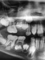Leczenie techniką regeneracji wgłobionego zęba przyczynowego ropnia dołu nadkłowego