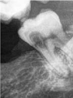 Inwazyjna resorpcja przyszyjkowa zęba 37