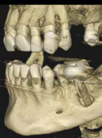 Powtórne leczenie kanałowe, dekompresja torbieli i jej późniejsze usunięcie ze sterowaną regeneracją kości, czyli krótka historia długiego leczenia zębów 35 i 36