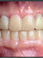 Wykonanie kompleksowej rekonstrukcji protetycznej w przebiegu osteoarthritis lewego stawu skroniowo‑żuchwowego w oparciu o diagnostykę obrazową – opis przypadku