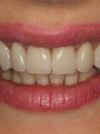 Rekonstrukcja estetyczna  uśmiechu za pomocą koron  i licówek pełnoceramicznych. Opis przypadku