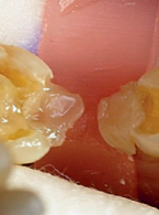 Most kompozytowy. Opis przypadku