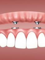 Zastosowanie protez typu  overdenture w leczeniu bezzębia. Przegląd piśmiennictwa