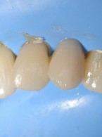 Natychmiastowa odbudowa kła szczęki  po utracie przetrwałego zęba mlecznego