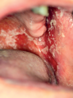 Kandydoza jamy ustnej. Część I: etiologia, klasyfikacja, obraz kliniczny