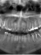 Ponowne leczenie endodontyczne  zębów przedtrzonowych z kanałami  bocznymi i deltą korzeniową. Opis dwóch przypadków