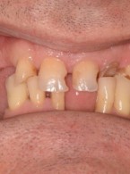 Kompleksowa rehabilitacja zachowawczo-protetyczna pacjenta z zaburzeniami zwarcia – opis przypadku