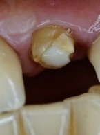 Adhezja w stomatologii rekonstrukcyjnej