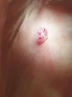 Leczenie naczyniaka jamistego tętnicy podniebiennej laserem dużej mocy- opis przypadku