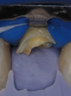Odbudowa zęba siecznego bocznego szczęki na wkładzie z włókna szklanego