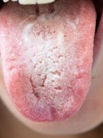 Kandydoza jamy ustnej. Część II: diagnostyka i leczenie