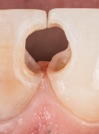 REPORTAŻ KLINICZNY: Zarządzanie przebarwionymi tkankami po leczeniu endodontycznym w bezpośrednich rekonstrukcjach kompozytowych
