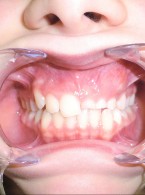Zęby nadliczbowe – przegląd piśmiennictwa i opis dwóch przypadków