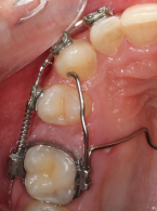 Odtworzenie całkowitego braku miejsca dla drugiego zęba  przedtrzonowego w szczęce za pomocą stałych aparatów grubołukowych. Opis przypadku