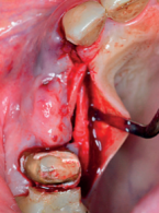 Wykorzystanie autogennej tkanki w procedurach augmentacyjnych zwiększających szerokość i objętość tkanek skeratynizowanych przed implantacją 