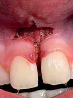 Zabieg frenulektomii techniką mieszaną. Opis przypadku