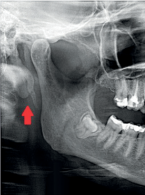 Zespół wydłużonego wyrostka rylcowatego – zespół Eagle'a