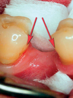 Zastosowanie materiału złożonego Boston i Włókien Kompozytowych. Opis przypadku