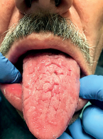 Zespół Melkerssona-Rosenthala – problemy z diagnostyką i leczeniem. Opis przypadku