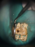 SPECJALISTA RADZI: Leczenie endodontyczne zęba z kanałem typu C
