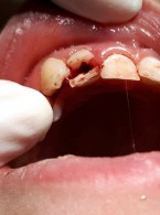 Ekstruzja chirurgiczna jako sposób postępowania w złamaniach koronowo-korzeniowych u pacjentów w wieku rozwojowym. Opis przypadku 