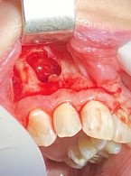 Resekcja wierzchołka korzenia z zastosowaniem L-PRF. Opis przypadków