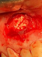 Chirurgiczne leczenie torbieli korzeniowej z zastosowaniem lasera Er,Cr:YAG. Opis przypadku
