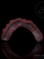 Protezy typu overdenture osadzone na implantach za pomocą precyzyjnych elementów retencyjnych - przegląd i porównanie dostępnych rozwiązań