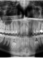 Dodatkowe zęby przedtrzonowe – opis przypadku