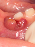 Jednoogniskowa postać histiocytozy z komórek Langerhansa z zajęciem trzonu żuchwy u 11-miesięcznego pacjenta. Opis przypadku