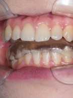 Terapia szynami zgryzowymi – wskazania w wybranych sytuacjach klinicznych na podstawie przeglądu piśmiennictwa