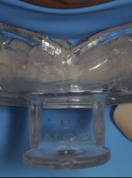 Odbudowa zębów przednich szczęki z wykorzystaniem transparentnego indeksu silikonowego