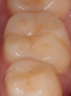 Ubytki erozyjne wśród młodzieży – etiologia, obraz kliniczny i profilaktyka na podstawie piśmiennictwa i własnych obserwacji