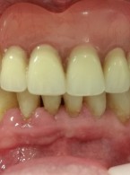 Leczenie starcia patologicznego zębów z wykorzystaniem materiału kompozytowego w przypadku kompleksowej rehabilitacji protetycznej  z odbudową utraconej wysokości zwarcia