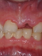 Kompromisowa odbudowa zębów siecznych szczęki z wykorzystaniem włókna szklanego w celu uzupełnienia utraconego zęba
