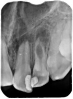 Resorpcja wewnętrzna zapalna korzenia zęba – opis przypadku