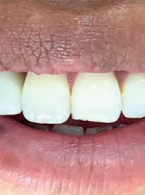 Planowanie leczenia endodontycznego od A do Z. Klucz do długotrwałego sukcesu. Opis przypadku