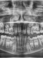 Reinkluzja zębów mlecznych. Opis przypadku klinicznego