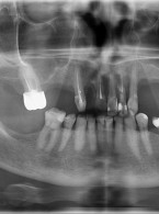Ponowne leczenie endodontyczne dwukorzeniowego zęba 22. Opis przypadku