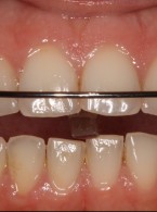 Diagnostyka funkcjonalna w procesie planowania leczenia u pacjentów z zaburzeniami skroniowo‑żuchwowymi oraz nieprawidłowościami okluzji