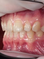 Rehabilitacja funkcjonalna zaburzeń okluzji oraz stawu skroniowo‑żuchwowego z elementami szynoterapii