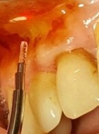 Wykorzystanie lasera Er:YAG w leczeniu liszaja płaskiego jamy ustnej. Opis przypadku