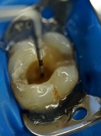 Odbudowa zębów bocznych. Techniki kliniczne stosowane w rekonstrukcjach bezpośrednich